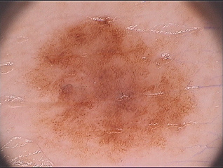 Muttermal dermatoskopisch